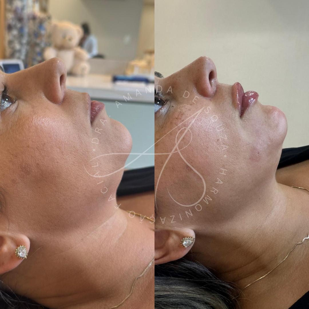 Bioestimulador facial na Savassi em Belo Horizonte para rejuvenescimento natural e melhora da pele