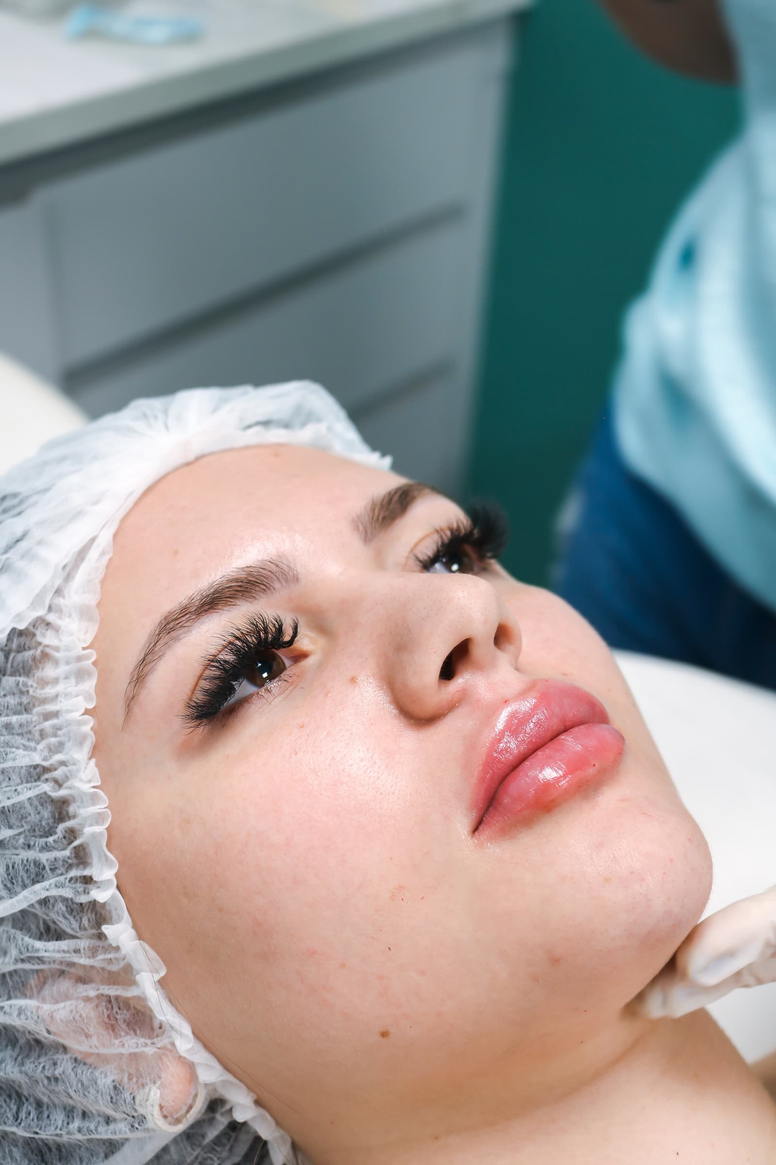 Botox em Belo Horizonte na Savassi para suavização de linhas de expressão