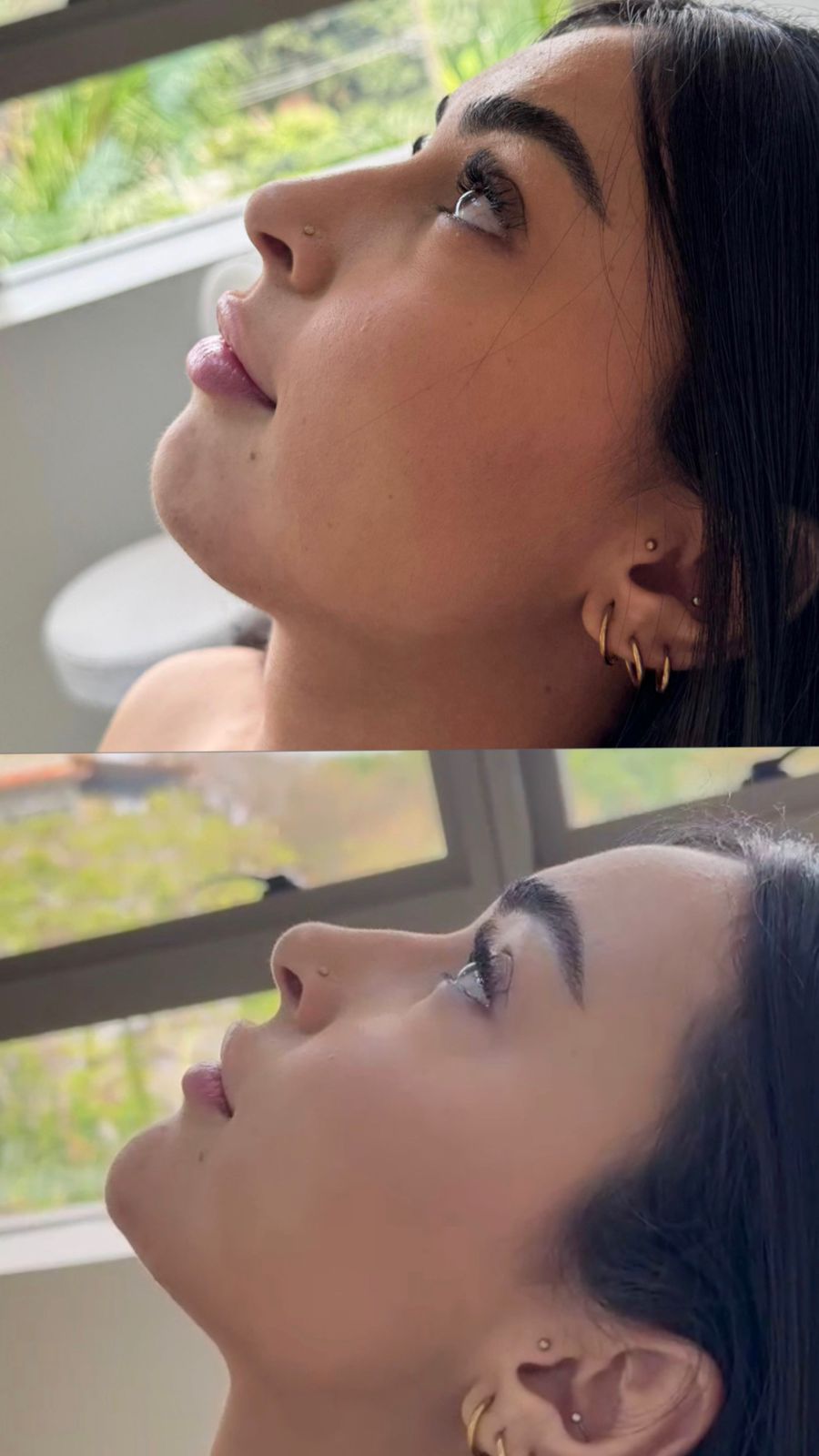 Harmonização facial natural na Savassi em Belo Horizonte com planejamento personalizado