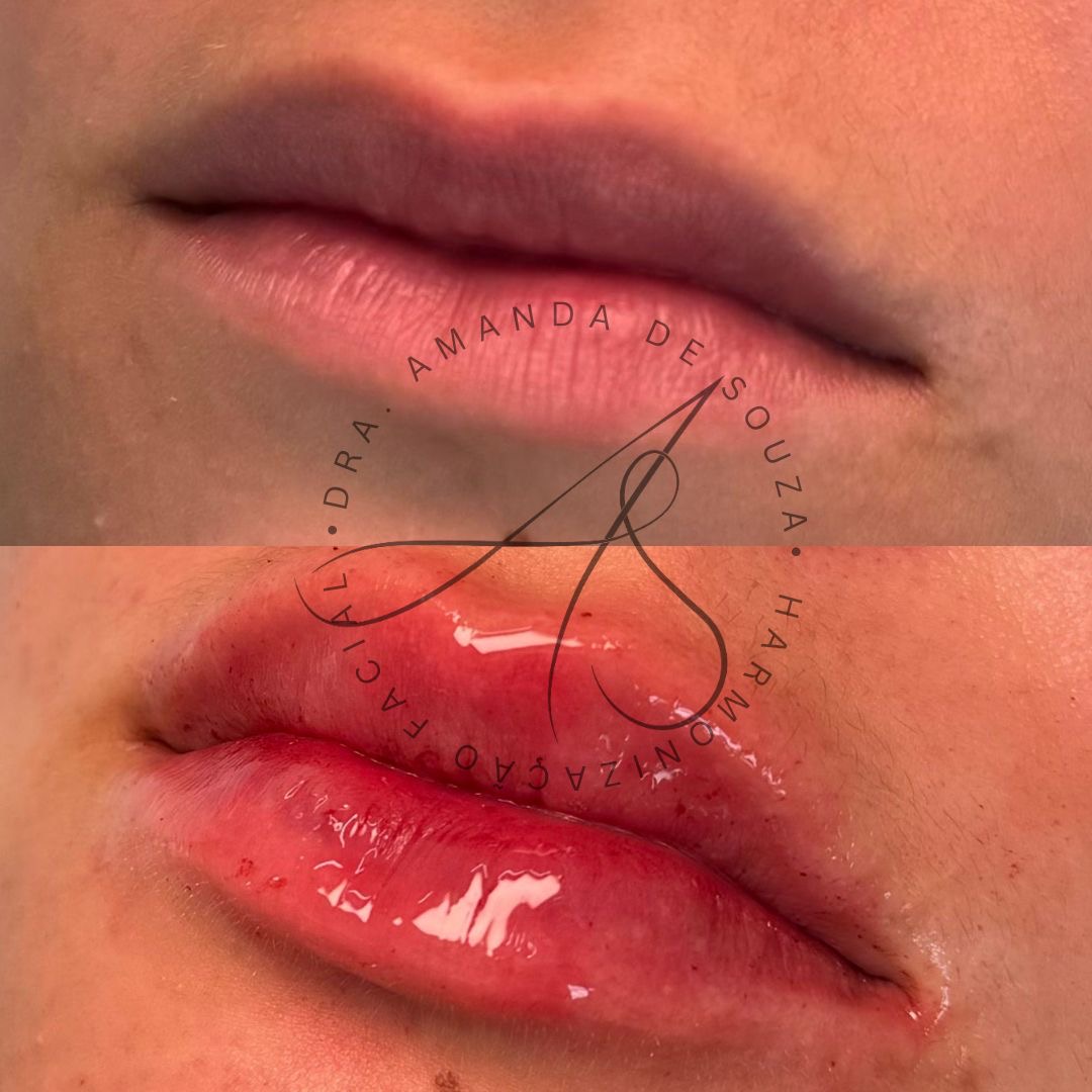 Preenchimento facial e labial na Savassi em Belo Horizonte com resultado natural e elegante